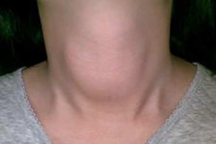 甲减女性颈部图