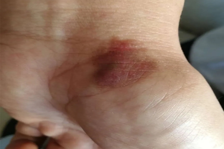 手腕海绵状血管瘤图