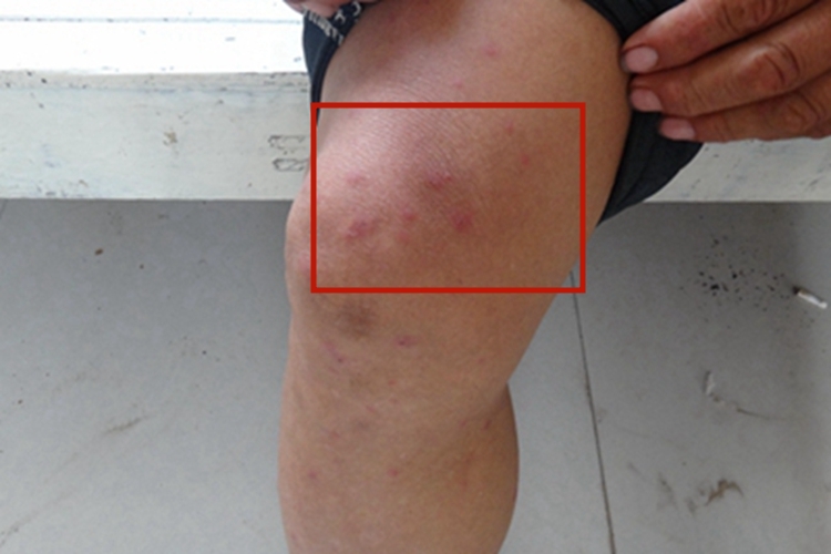 机械性紫癜下肢紫红斑图