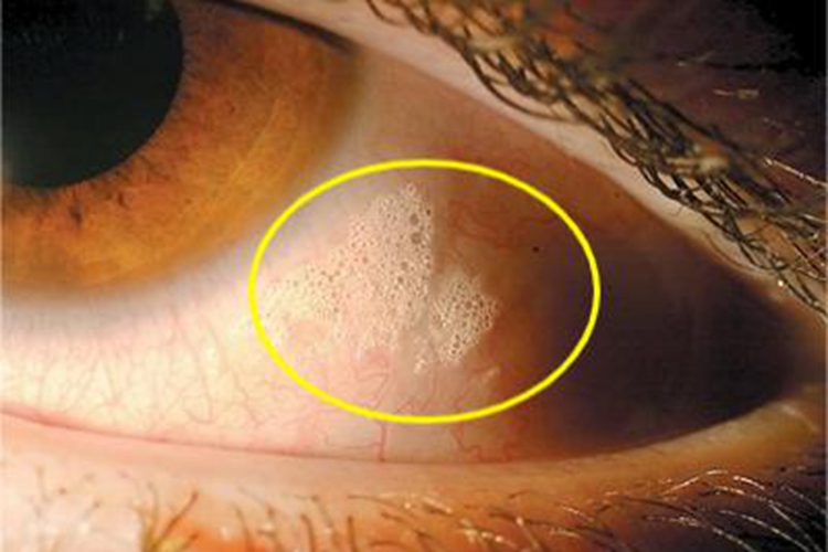 角膜软化症结膜上皮角化斑图 角膜软化症结膜上皮角化斑图