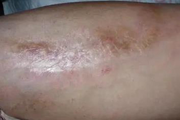 局限性硬皮病大腿症状图