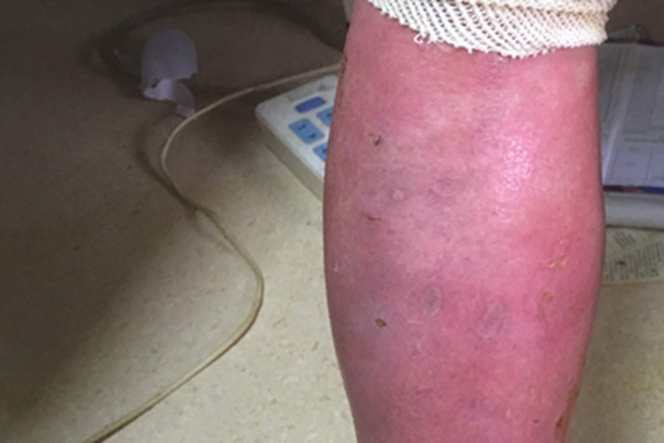 红斑性肢痛症小腿红肿结痂图 红斑性肢痛症小腿红肿结痂图