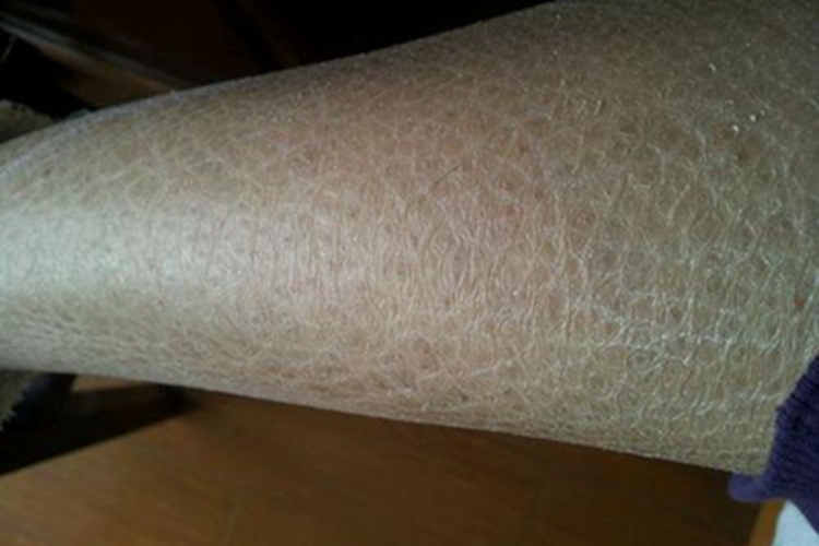 毛囊性鱼鳞病纹图 毛囊性鱼鳞病纹图