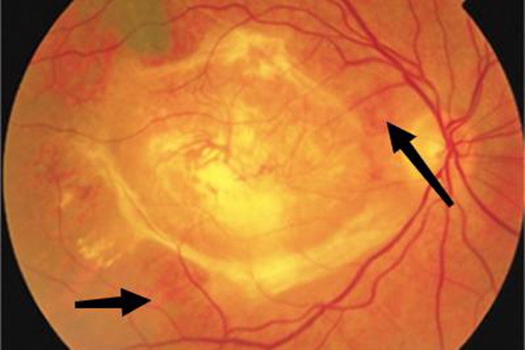 渗出性老年性黄斑部变性血丝图