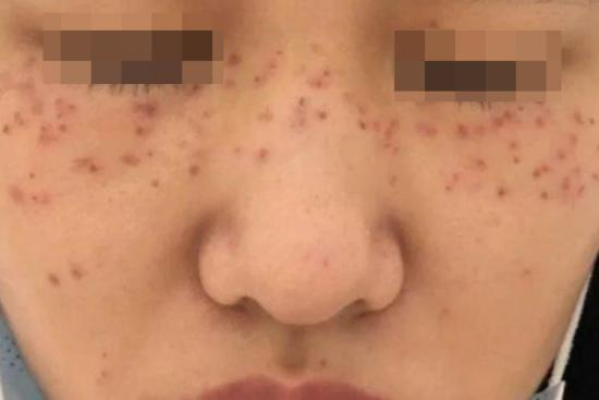 药水点斑早期红肿图 药水点斑早期红肿图