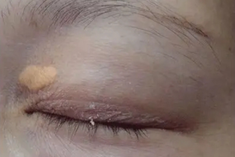 睑黄瘤眼角黄斑图 睑黄瘤眼角黄斑图