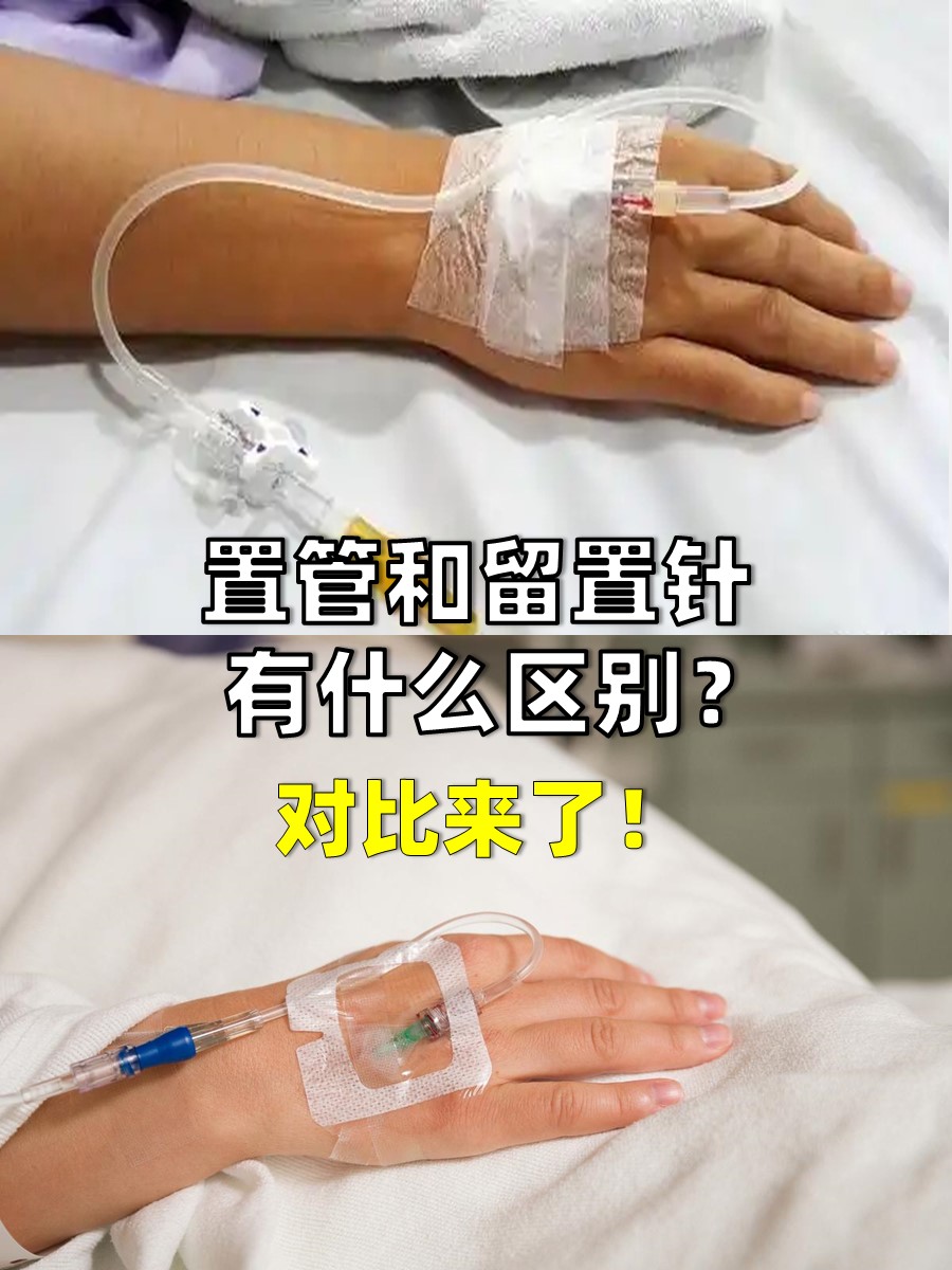 置管和留置针有什么区别？对比来了！