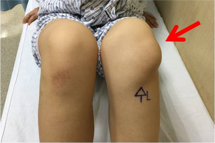 习惯性左侧髌骨外翻图