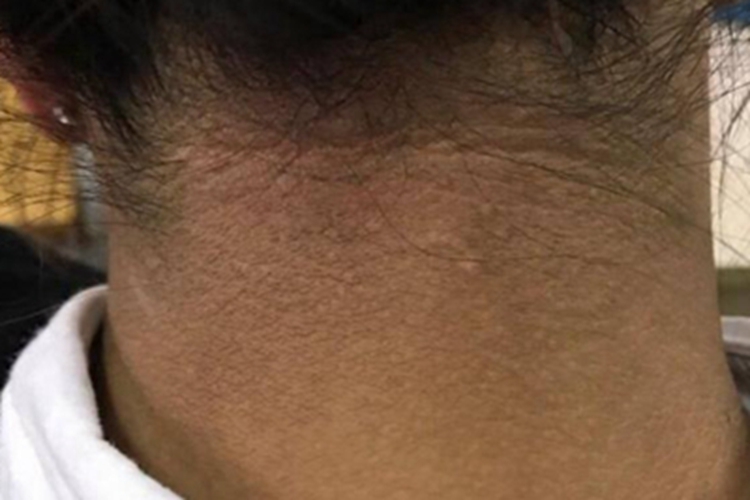 假性黑棘皮病颈部皮肤粗糙图