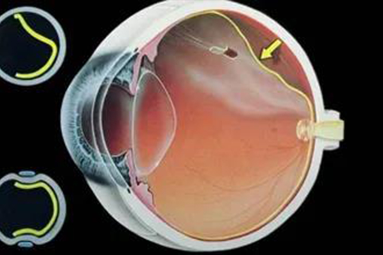 视网膜脱落闪光感图片