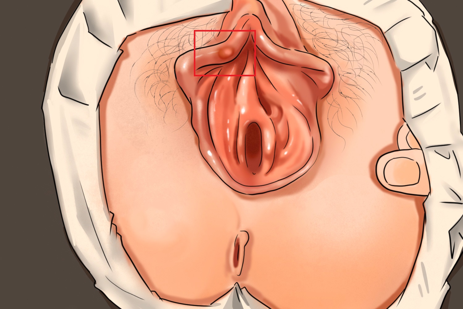 梅毒会阴部手绘图