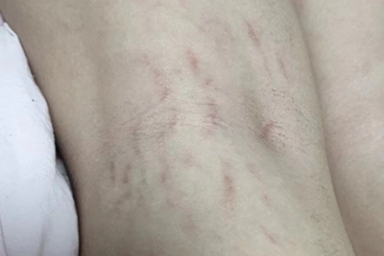 萎缩纹腘窝症状图