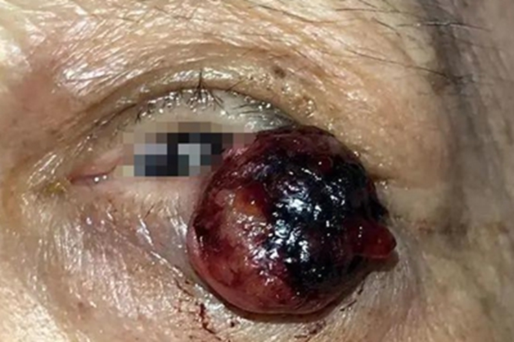 眼睑鳞状细胞癌包块图