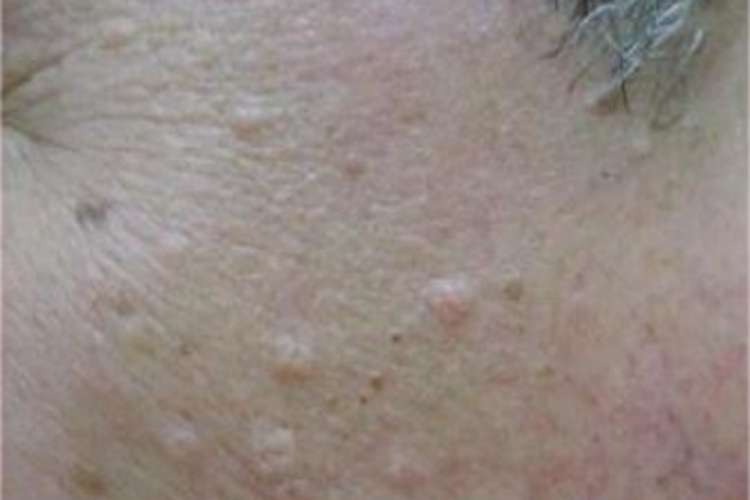 老年性皮脂腺增生面部有小疙瘩图 老年性皮脂腺增生面部有小疙瘩图