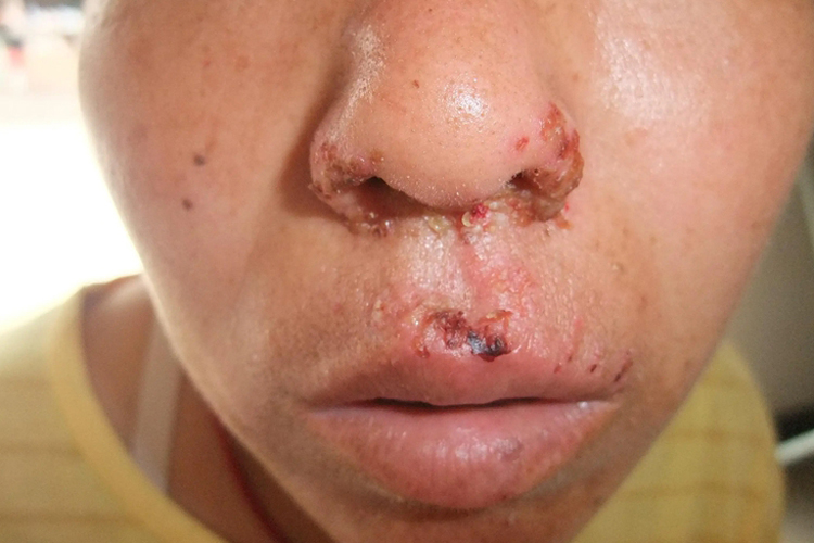 感冒后鼻子下面起疱疹图 感冒后鼻子下面起疱疹图