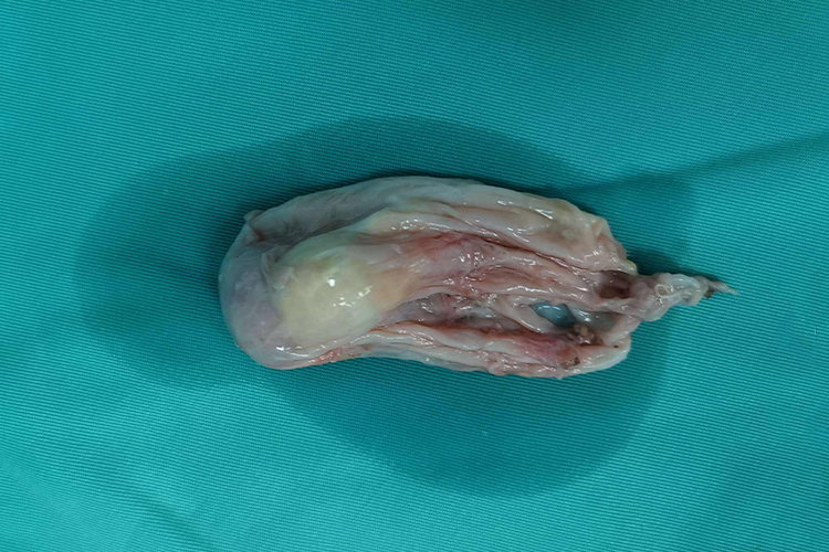 未成熟性畸胎瘤图