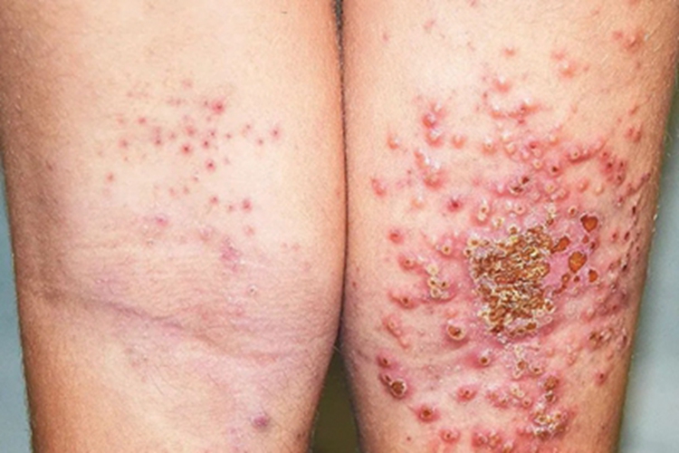 卡波西水痘样疹腘窝症状图