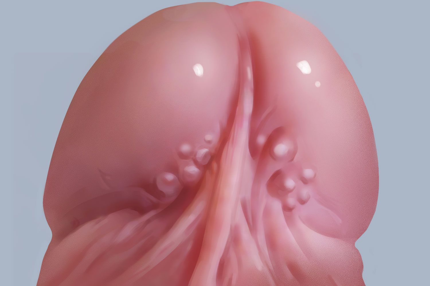 包皮系带两侧珍珠疹图 包皮系带两侧珍珠疹图