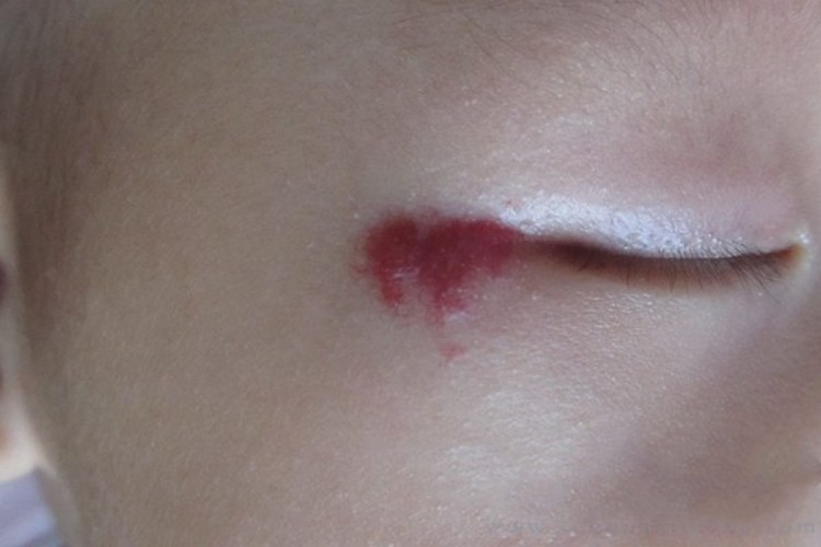 蔓状血管瘤眼角小红疙瘩图