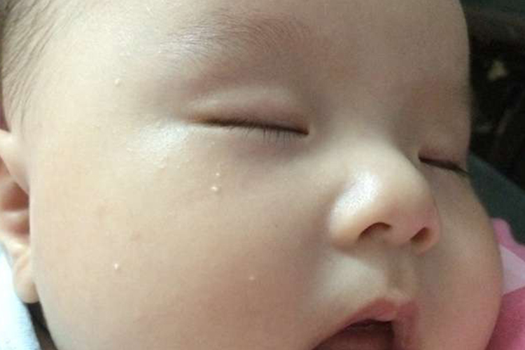宝宝脸上长小米粒图片