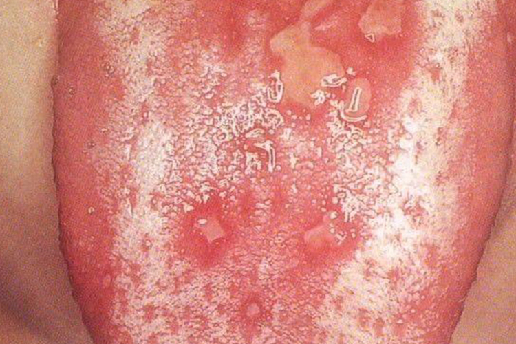 复发性疱疹性口炎舌头水疱图