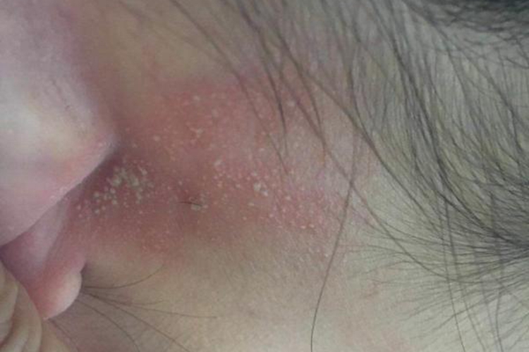 耳后湿疹红斑图
