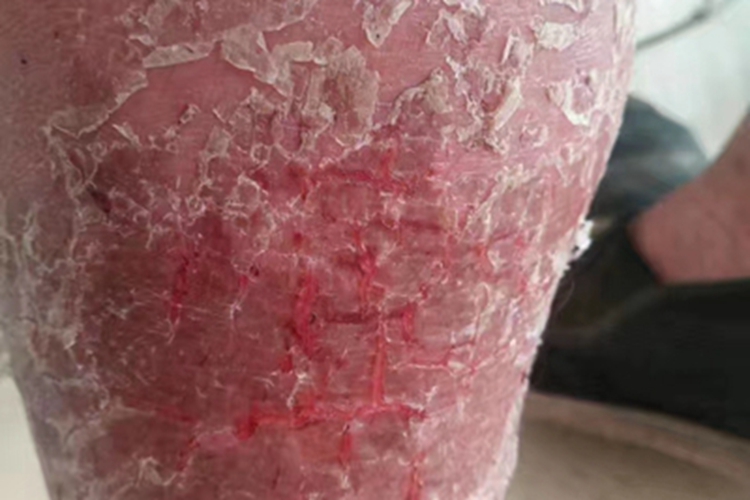 红皮病型银屑病小腿脱屑图