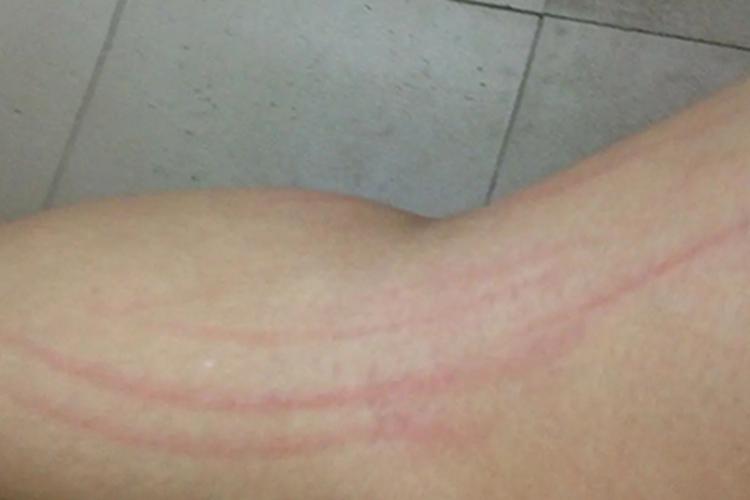 人工皮炎腿条纹图