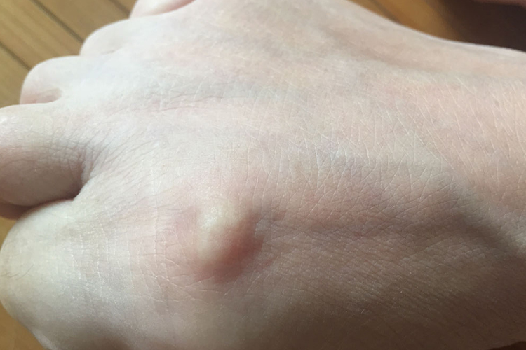 脚上长了脂肪瘤图 脚上长了脂肪瘤图