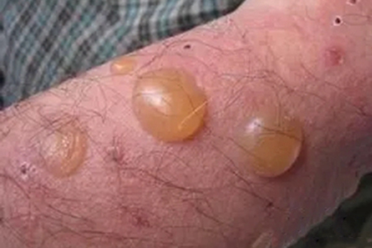 副肿瘤性天疱疮胳膊水疱图