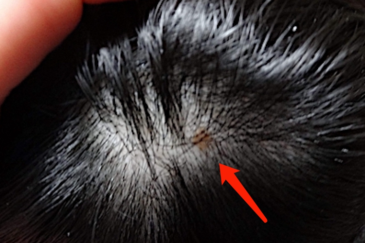 毛结节菌病头发症状图