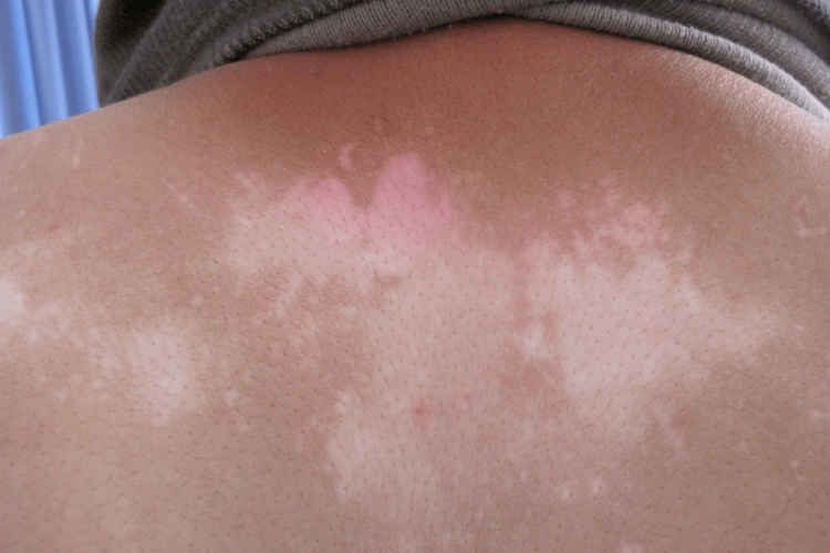 白癜风后背白斑图 白癜风后背白斑图