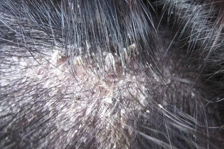 头皮鳞屑型脂溢性皮炎图