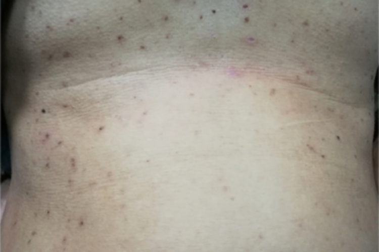 青年成人期特应性皮炎腹部症状图 青年成人期特应性皮炎腹部症状图