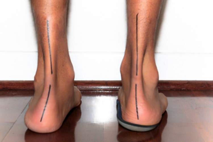 平足症脚后跟向外翘图 平足症脚后跟向外翘图