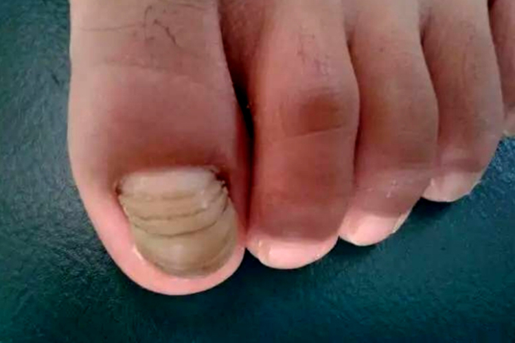 甲横沟脚趾甲横纹断层图 甲横沟脚趾甲横纹断层图