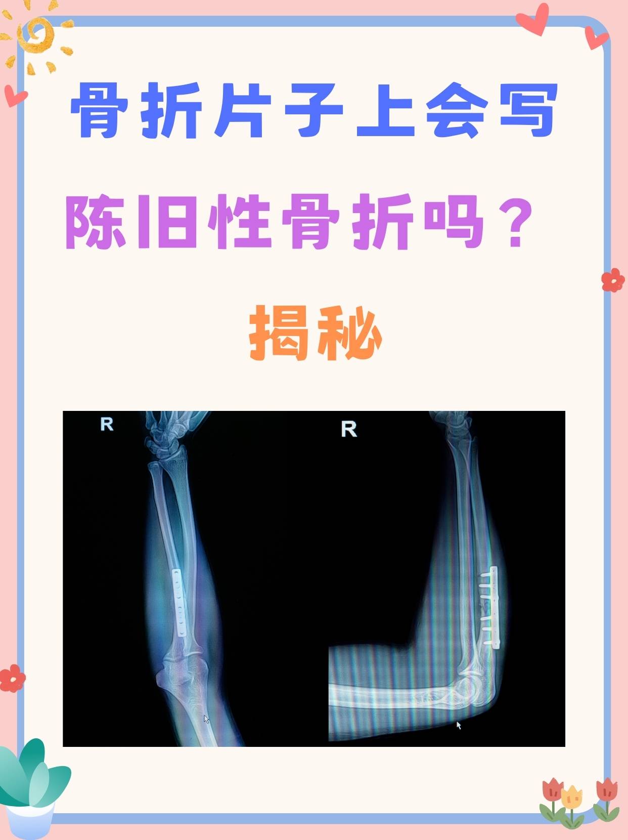 骨折片子上会写陈旧性骨折吗？揭秘