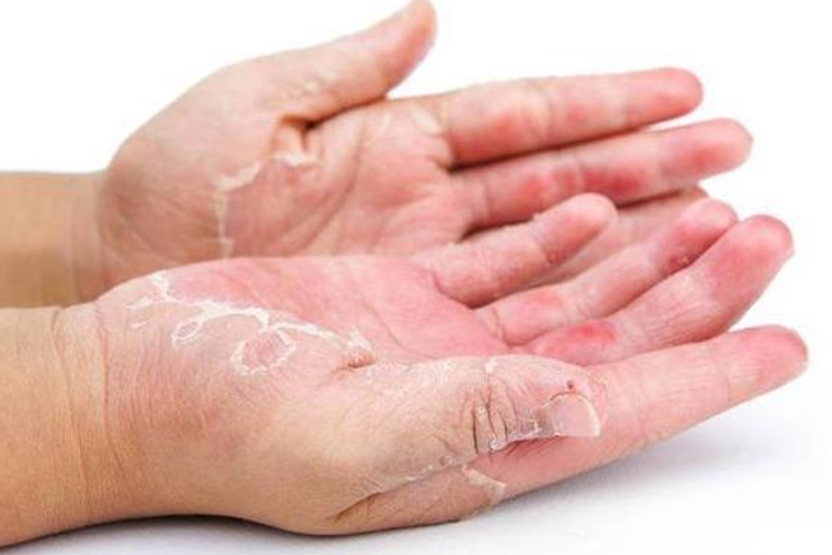 剥脱性角质松解症图