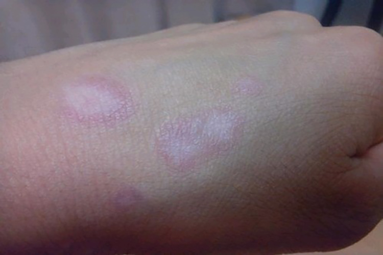 边缘隆起性白斑图