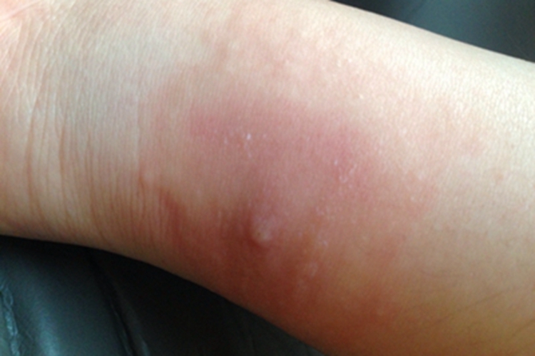 蚁蜇伤小腿小红疙瘩图 蚁蜇伤小腿小红疙瘩图