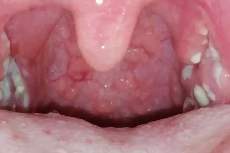 慢性扁桃体炎淋巴增生图