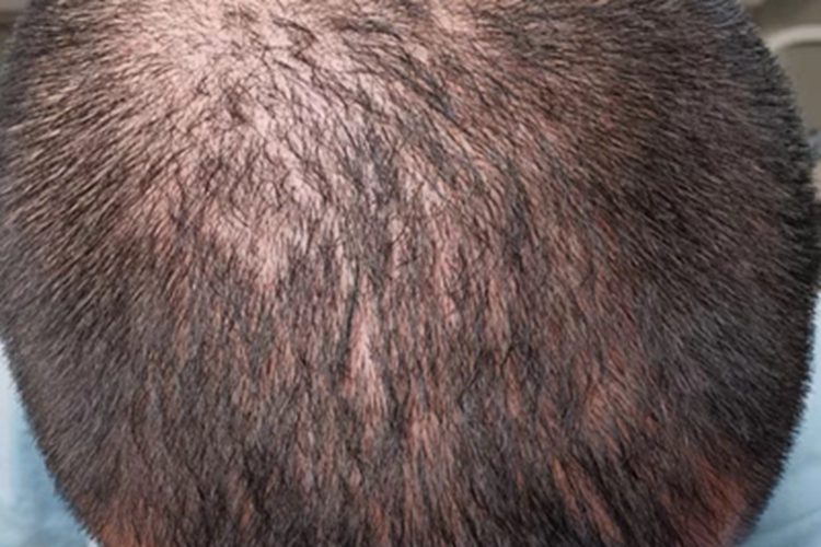 雄激素性脱发头顶有些脱发图