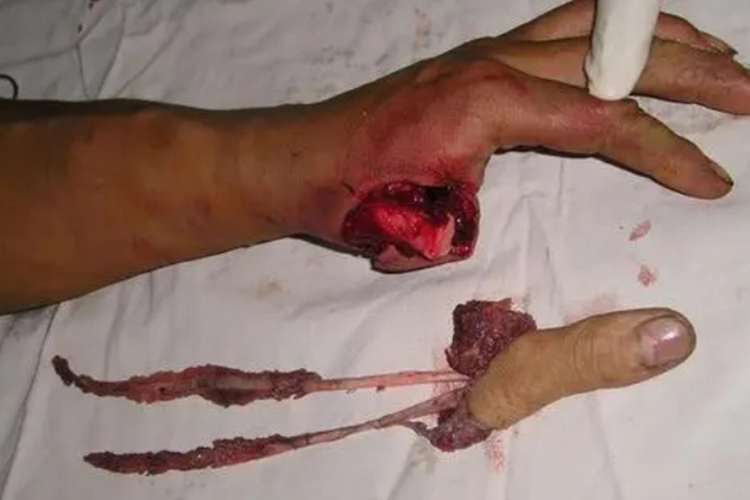 手指撕脱伤图