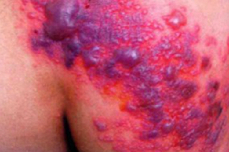 艾滋病感染性皮肤损害软包图 艾滋病感染性皮肤损害软包图