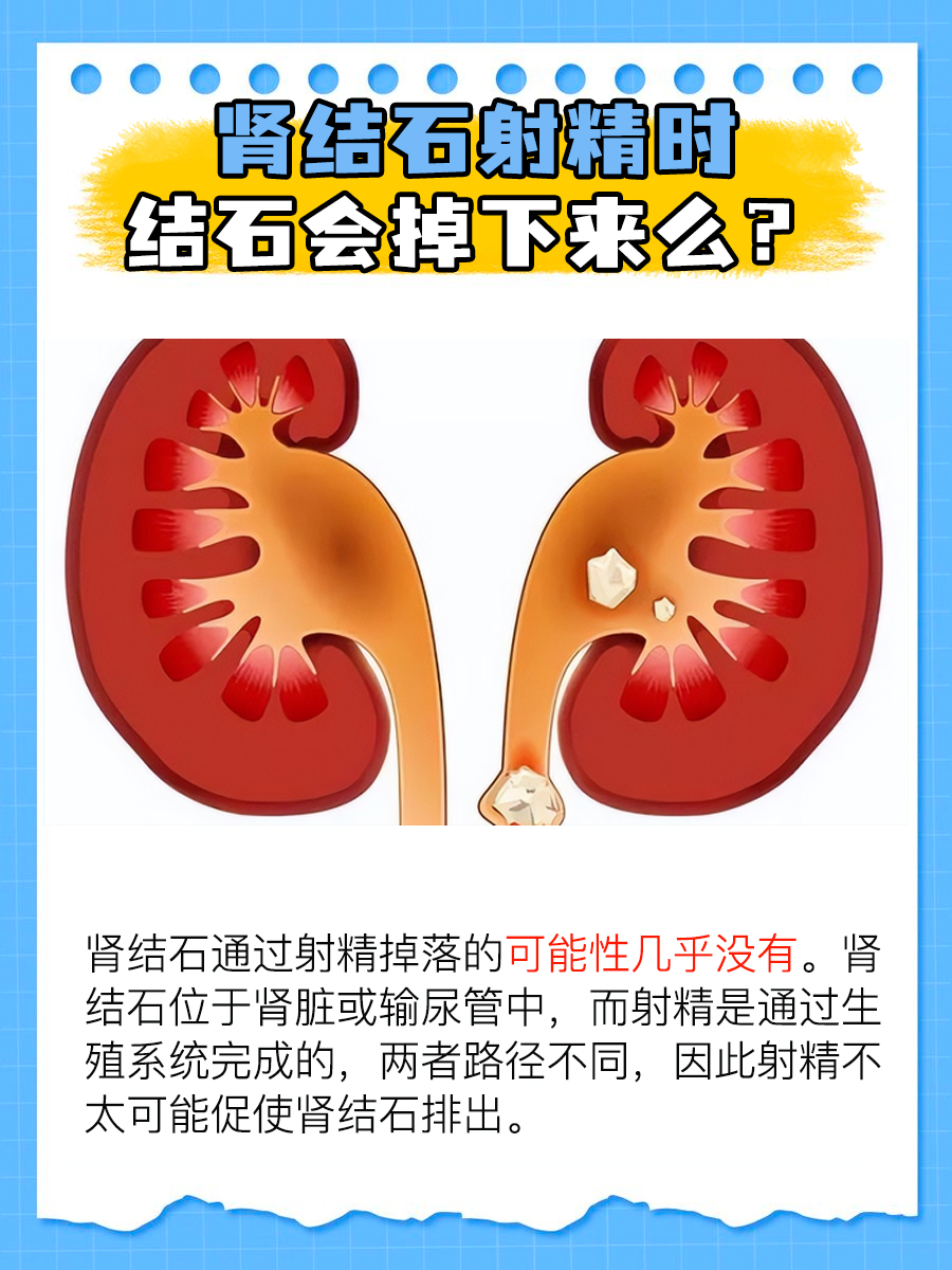射精排石？肾结石是否会因此脱落？