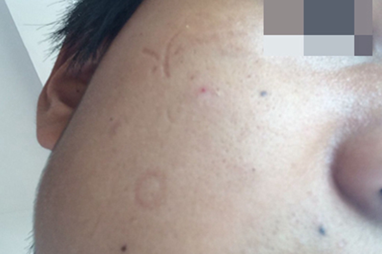 继发性斑状萎缩坑图