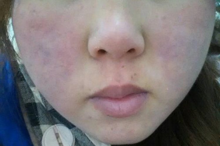 气滞血瘀面色青紫图