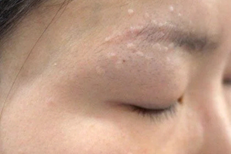 汗管瘤眉毛丘疹图