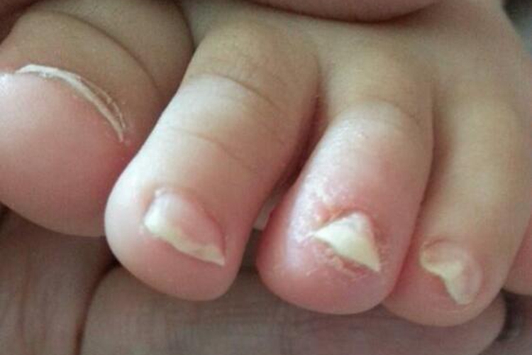 婴幼儿甲真菌病图