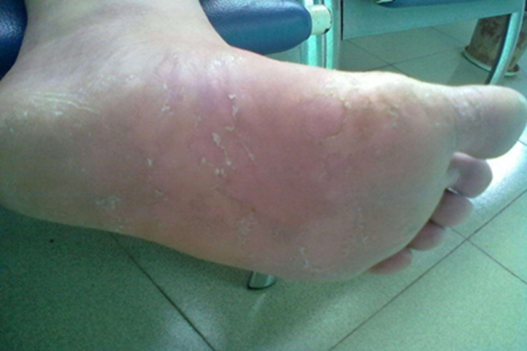 弥漫性掌跖角化病脚底脱皮图